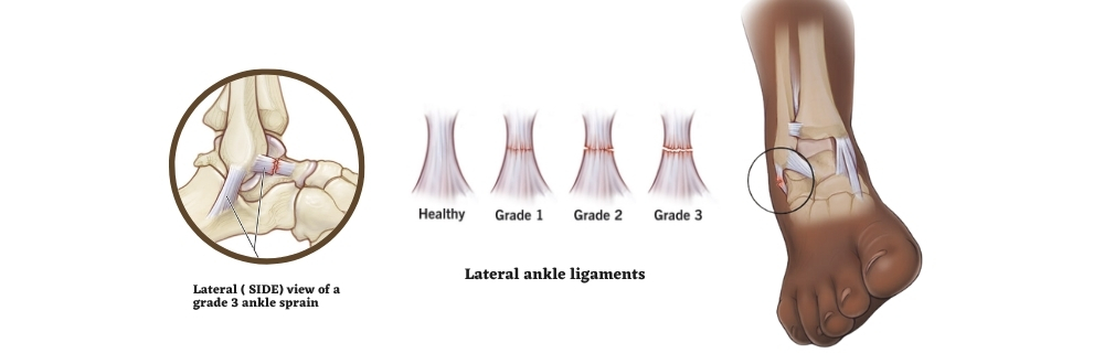 Grades of ankle sprain