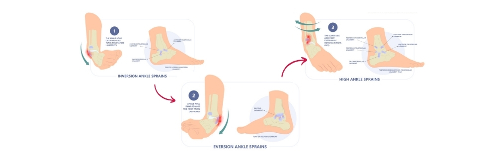 Types of Ankle Sprains