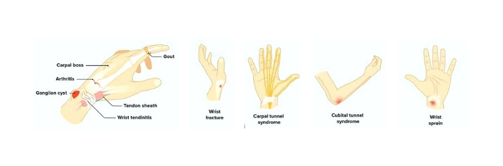 Wrist Pain Causes