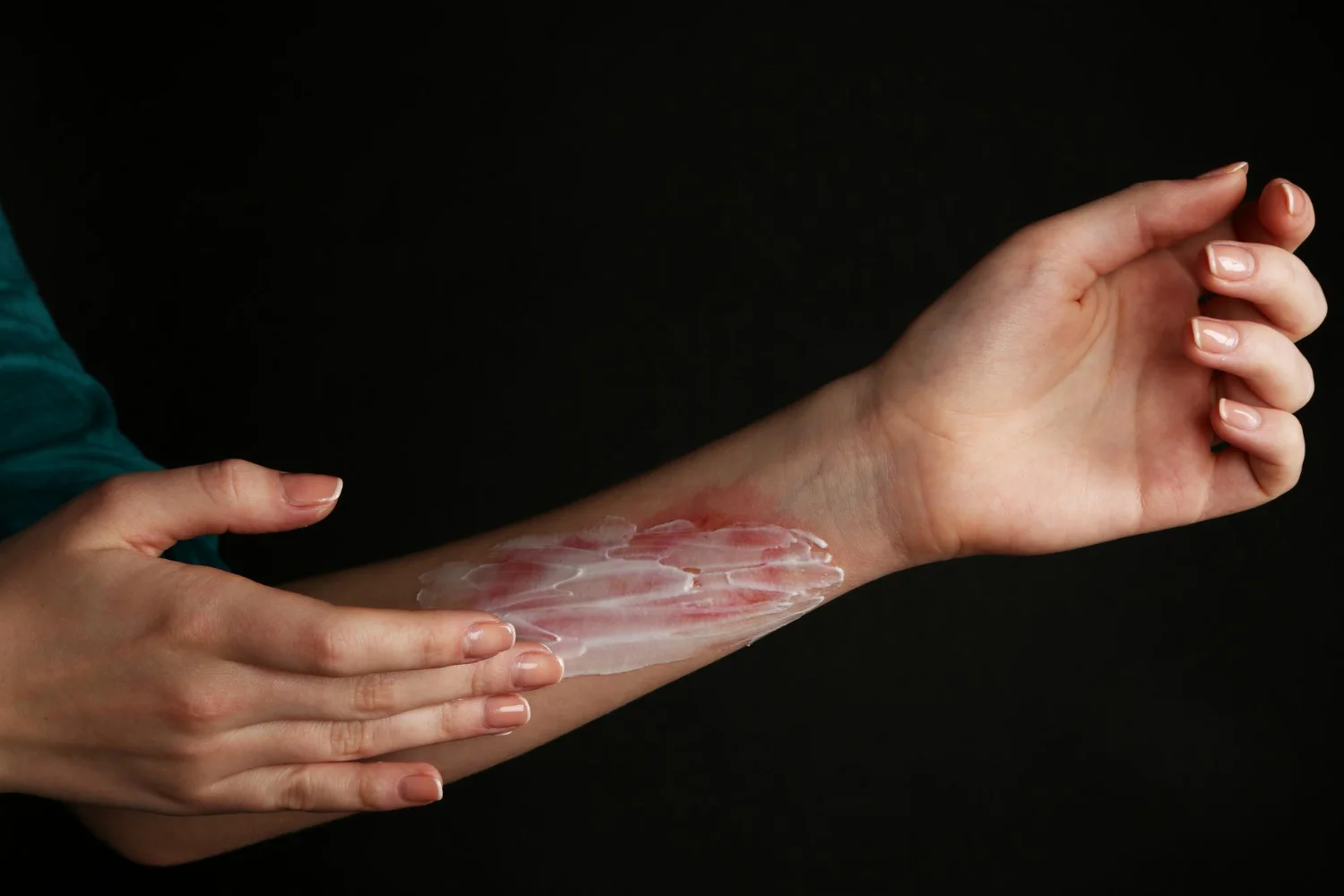Lithium-Ion Battery Injuries